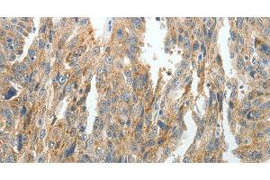 Immunohistochemistry of paraffin-embedded Human ovarian cancer tissue using PRDX5 Polyclonal Antibody at dilution 1:40 (Peroxiredoxin 5 Antikörper)