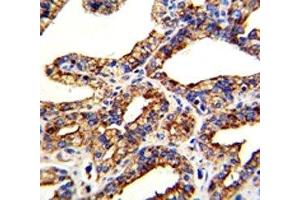 IHC analysis of FFPE human prostate carcinoma with TROP2 antibody (TACSTD2 Antikörper  (AA 162-190))