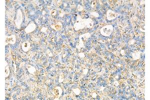 ABIN6257222 and ABIN6276028 at 1/100 staining Human liver cancer by IHC-P. (GPR17 Antikörper  (C-Term))