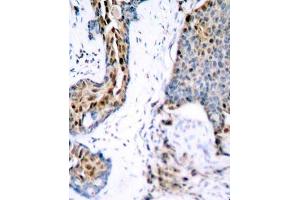 Immunohistochemistry of paraffin-embedded human breast carcinoma using Phospho-ESR1-S118 antibody (ABIN2987431). (Estrogen Receptor alpha Antikörper  (pSer118))