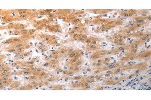 Immunohistochemistry of paraffin-embedded Human liver cancer using NQO2 Polyclonal Antibody at dilution of 1:50 (NQO2 Antikörper)