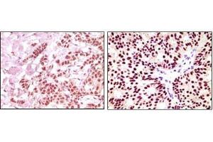 Immunohistochemical analysis of paraffin-embedded human breast carcinoma, using ER-alpha antibody showing nuclear expression with DAB staining. (Estrogen Receptor alpha Antikörper  (AA 410-592))