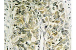 Immunohistochemical analysis of paraffin-embedded human prostate cancer tissue using LGALS8 polyclonal antibody . (LGALS8 Antikörper)