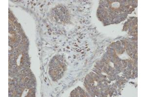 IHC-P Image Immunohistochemical analysis of paraffin-embedded human endo mitral ovarian cancer, using PPM1K, antibody at 1:100 dilution. (PPM1K Antikörper)