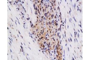 Formalin-fixed and paraffin embedded human colon carcinoma labeled with Anti-SynCAM/TSLC1 Polyclonal Antibody, Unconjugated  at 1:200 followed by conjugation to the secondary antibody and DAB staining. (CADM1 Antikörper  (AA 365-442))
