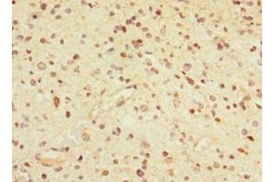 Immunohistochemistry of paraffin-embedded human glioma using ABIN7153488 at dilution of 1:100