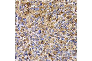 Immunohistochemistry of paraffin-embedded mouse cancer using UBE2R2 antibody at dilution of 1:100 (x400 lens).