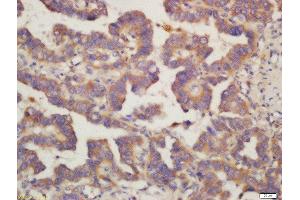 Formalin-fixed and paraffin embedded human lung carcinoma labeled with Rabbit Anti-PIG3 Polyclonal Antibody, Unconjugated (ABIN763046) at 1:200 followed by conjugation to the secondary antibody and DAB staining (MRPL41 Antikörper  (AA 151-250))
