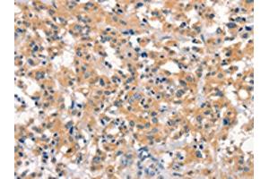 The image on the left is immunohistochemistry of paraffin-embedded Human thyroid cancer tissue using ABIN7190538(EID3 Antibody) at dilution 1/15, on the right is treated with synthetic peptide. (EID3 Antikörper)