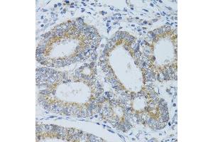 Immunohistochemistry of paraffin-embedded human colon carcinoma using DNAJC19 antibody. (DNAJC19 Antikörper  (AA 1-116))