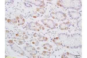 Formalin-fixed and paraffin embedded human colon carcinoma labeled with Anti-DENND2D Polyclonal Antibody, Unconjugated (ABIN1385457) at 1:200 followed by conjugation to the secondary antibody and DAB staining