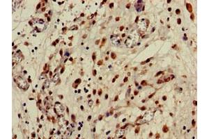 Immunohistochemistry of paraffin-embedded human lung cancer using ABIN7146768 at dilution of 1:100 (CPB2 Antikörper  (AA 225-372))