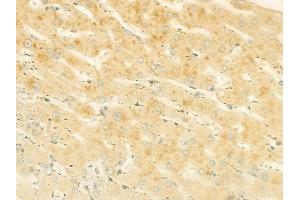 ABIN6264925 and ABIN6278520 at 1/100 staining human hepatocellular carcinoma by IHC-P. (SGCB Antikörper  (N-Term))