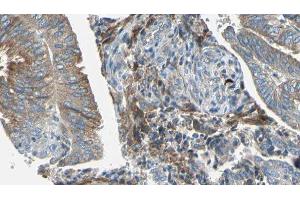 ABIN6277681 at 1/100 staining Human cervical cancer tissue by IHC-P. (OCA2 Antikörper  (N-Term))