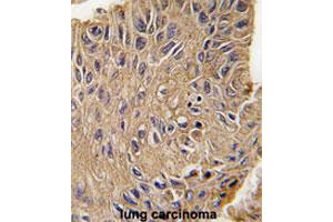Formalin-fixed and paraffin-embedded human lung carcinomareacted with ANTXR1 polyclonal antibody , which was peroxidase-conjugated to the secondary antibody, followed by AEC staining. (ANTXR1 Antikörper  (Tyr382))