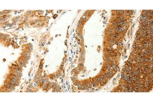 Immunohistochemistry of paraffin-embedded Human colon cancer using RARRES1 Polyclonal Antibody at dilution of 1:60 (RARRES1 Antikörper)
