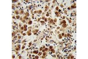 Immunohistochemistry analysis in human testis carcinoma (Formalin-fixed, Paraffin-embedded) using SOHLH1 / TEB2  Antibody (N-term), followed by peroxidase conjugation of the secondary antibody and DAB staining. (SOHLH1 Antikörper  (N-Term))