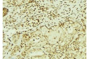 ABIN6272900 at 1/100 staining Human breast cancer tissue by IHC-P. (CEMIP Antikörper  (C-Term))