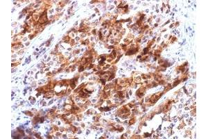 ABIN6383809 to Glypican-3 was successfully used to stain malignant cells in human hepatocellular carcinoma sections. (Rekombinanter Glypican 3 Antikörper)