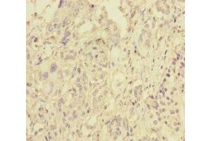 Immunohistochemistry of paraffin-embedded human pancreatic cancer using ABIN7145609 at dilution of 1:100 (Pallidin Antikörper  (AA 1-170))
