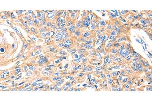 Immunohistochemistry of paraffin-embedded Human esophagus cancer using MVP Polyclonal Antibody at dilution of 1:30