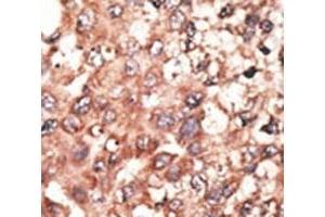 IHC analysis of FFPE human hepatocarcinoma tissue stained with the BMP5 antibody