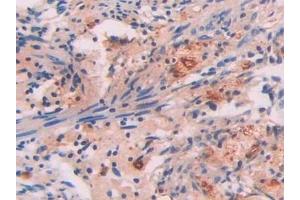 Detection of SAP in Human Lung cancer Tissue using Polyclonal Antibody to Serum Amyloid P Component (SAP) (APCS Antikörper  (AA 23-223))