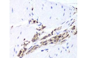 Immunohistochemistry of paraffin-embedded Human gastric cancer using TPPP3 Polyclonal Antibody at dilution of 1:100 (40x lens). (TPPP3 Antikörper)