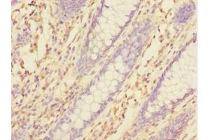 Immunohistochemistry of paraffin-embedded human colon cancer using ABIN7172004 at dilution of 1:100