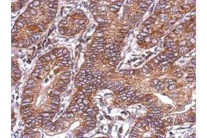 IHC-P Image Immunohistochemical analysis of paraffin-embedded human colon carcinoma, using Activin A Receptor Type IC, antibody at 1:500 dilution. (ACVR1C/ALK7 Antikörper  (Center))