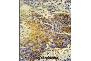 MRPS24 antibody immunohistochemistry analysis in formalin fixed and paraffin embedded human lung carcinoma followed by peroxidase conjugation of the secondary antibody and DAB staining. (MRPS24 Antikörper  (AA 21-50))