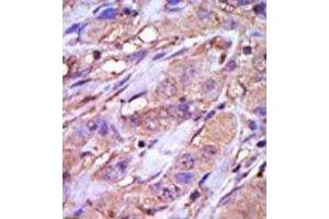 Formalin-fixed and paraffin-embedded human cancer tissue reacted with the primary antibody, which was peroxidase-conjugated to the secondary antibody, followed by DAB staining. (CK1 epsilon Antikörper  (C-Term))