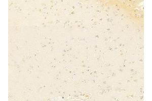 ABIN6261830 and ABIN6278360 at 1/100 staining human glioblastoma by IHC-P.