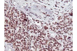 Immunohistochemical staining of paraffin-embedded Adenocarcinoma of Human breast tissue using anti-HOXC11 mouse monoclonal antibody. (HOXC11 Antikörper  (AA 1-304))