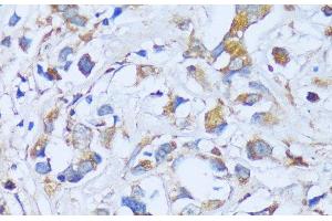 Immunohistochemistry of paraffin-embedded Human breast cancer using ACADSB Polyclonal Antibody at dilution of 1:100 (40x lens). (ACADSB Antikörper)