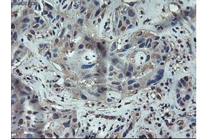 Immunohistochemical staining of paraffin-embedded Carcinoma of liver using anti-APOM (ABIN2452530) mouse monoclonal antibody. (Apolipoprotein M Antikörper  (AA 23-188))