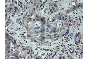 Immunohistochemical staining of paraffin-embedded Carcinoma of liver using anti-APOM (ABIN2452530) mouse monoclonal antibody.
