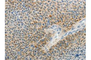 The image on the left is immunohistochemistry of paraffin-embedded Human liver cancer tissue using ABIN7189711(AGAP1 Antibody) at dilution 1/25, on the right is treated with synthetic peptide. (AGAP1 Antikörper)