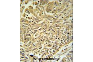 GSTK1 Antibody IHC analysis in formalin fixed and paraffin embedded lung carcinoma followed by peroxidase conjugation of the secondary antibody and DAB staining. (GSTK1 Antikörper  (AA 93-120))
