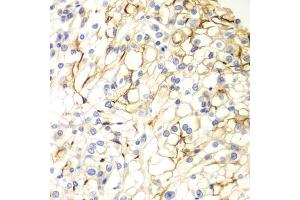 Immunohistochemistry of paraffin-embedded human kidney cancer using VANGL2 antibody. (VANGL2 Antikörper)