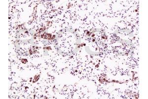 Formalin-fixed and paraffin embedded human lung carcinoma labeled with Anti-Dnmt1 Polyclonal Antibody, Unconjugated (ABIN671796) at 1:200, followed by conjugation to the secondary antibody and DAB staining (DNMT1 Antikörper  (AA 21-120))