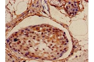 Immunohistochemistry of paraffin-embedded human breast cancer using ABIN7160901 at dilution of 1:100 (NDUFA4L2 Antikörper  (AA 48-87))