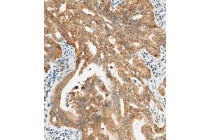 (ABIN657450 and ABIN2846476) staining CTAG1A in human gastric carcinoma tissue sections by Immunohistochemistry (IHC-P - paraformaldehyde-fixed, paraffin-embedded sections). (CTAG1A Antikörper  (N-Term))