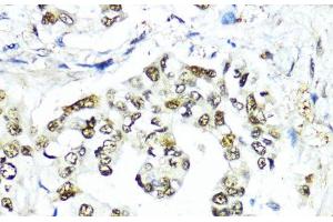 Immunohistochemistry of paraffin-embedded Human lung cancer using SUMO1 Polyclonal Antibody at dilution of 1:200 (40x lens). (SUMO1 Antikörper)