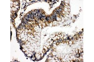 IHC-P: SOD2 antibody testing of human intestinal cancer tissue (SOD2 Antikörper  (N-Term))