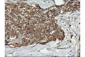 Immunohistochemical staining of paraffin-embedded Adenocarcinoma of Human breast tissue using anti-PFKP mouse monoclonal antibody. (PFKP Antikörper)