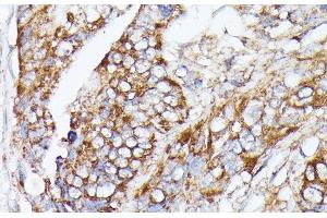 Immunohistochemistry of paraffin-embedded Human colon carcinoma using NUBP1 Polyclonal Antibody at dilution of 1:100 (40x lens). (NUBP1 Antikörper)