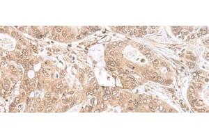 Immunohistochemistry of paraffin-embedded Human gastric cancer tissue using ETV3 Polyclonal Antibody at dilution of 1:25(x200) (ETV3 Antikörper)