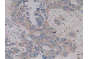 IHC-P analysis of Human Breast Cancer Tissue, with DAB staining. (MAP2K6 Antikörper  (AA 46-306))