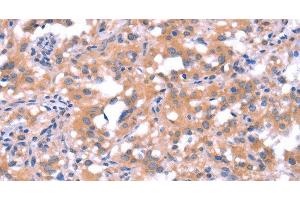 Immunohistochemistry of paraffin-embedded Human thyroid cancer tissue using FAT1 Polyclonal Antibody at dilution 1:40 (FAT1 Antikörper)